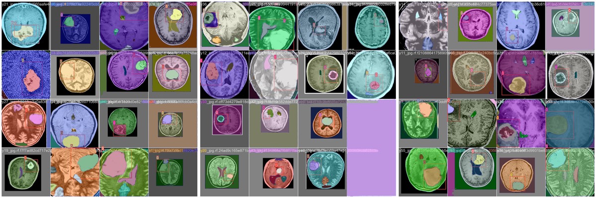 SAM 2 segmentation masks for medical-imaging experiment
