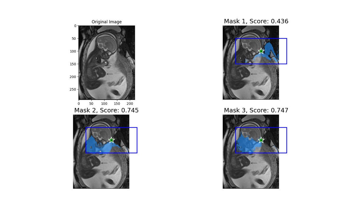 Fetus segmentation computer vision project preview